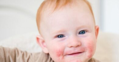 atopowe zapalenie skóry u niemowlęcia